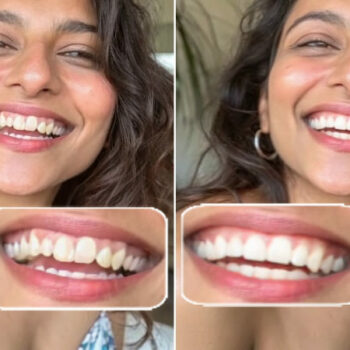 Best Straight Teeth Filter for the Perfect Smile - Cover Image