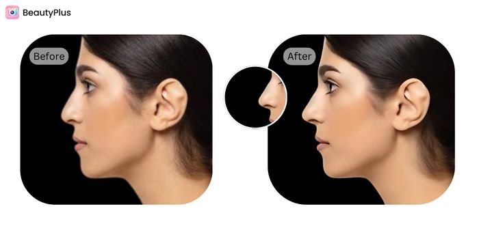 The Best Virtual Nose Job Filter For An Ideal Profile - Side Profile - Before & After